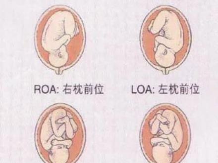 原来LOA意思是左枕前位😂😂😂