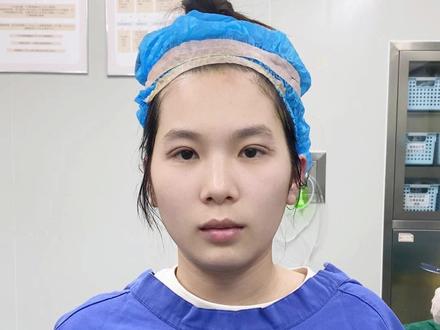 开扇双眼皮+眼尾上扬 #变美那些事 #双眼皮 #朱晓春双眼皮 #医疗健康训练创作营