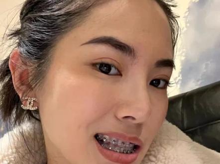 矫正牙齿选择什么样的牙套?金属自锁牙套和非自锁牙套结扎丝牙套有什么区别?金属牙套结扎丝的拧法?看完视频你会选择哪一种牙套那?陶瓷牙套更美观,但是易碎。#牙医日常 #牙套怎么选 #口腔健康