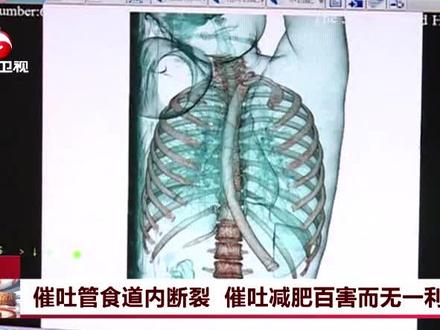 #警醒自己, #女子 用催吐管 #减肥 ,差点丢了命 !