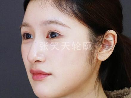 一位关注我10年的方圆脸粉丝#方脸#方圆脸#下颌角磨骨#轮廓#张笑天改脸型