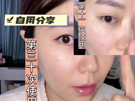 超真实反馈Jovs嫩肤仪的打卡变化,咱是不知道为啥别人几次就去掉全脸的黑黑点点。我用了30次的反馈来了!#亲测分享 #jovs #美容仪 #嫩肤仪 #淡斑