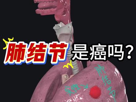 体检查出肺结节就是肺癌吗?一个视频讲清楚该不该慌 #关于肿瘤的那些事儿#全国肿瘤防治宣传周#抖出健康知识宝藏#医学科普#癌症
