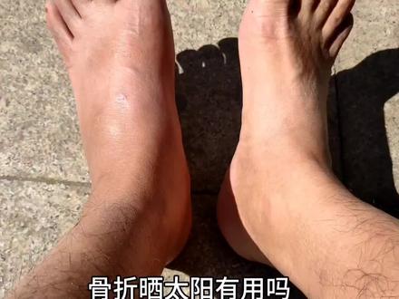 左脚骨折的第一百五十天,骨折晒太阳对骨折恢复有好处! #骨折康复 #骨折恢复记录