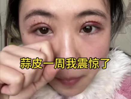 蒜皮一周恢复记录来啦,明显感觉更自然啦#双眼皮 #双眼皮蜕变记 #双眼皮恢复#双眼皮手术