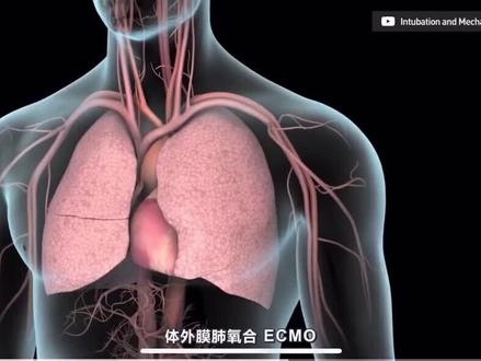 终极医疗器械#ecmo技术