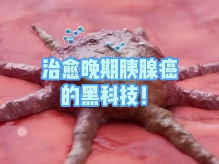 治愈晚期胰腺癌的黑科技诞生!