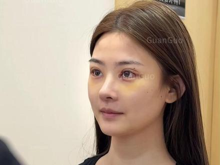 媚眼如丝~微微上扬的狐系眼真的好美! 出镜人已满二十五周岁并已签署出镜协议
仅为个案,不宣导任何医疗项目
如有不适请及时就医#眼综合#双眼皮修复管果#眼修复#双眼皮手术#管果双眼皮