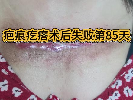 #疤痕疙瘩术后失败第85天#疤痕疙瘩#疤痕修复
增生了,医生让贴日本的小川令疤痕贴,是一种激素贴,视频里说错了,需要长期贴,说让我先贴一个月看看,现在贴了有5天,感觉增生的速度好像变快了,五天前还没这么鼓,不知道是不是精神作用,之前减张胶带三四天一换,皮肤压力没那么大,现在天天换天天换,皮肤都贴坏了…#手术疤痕怎么护理 #增生的疤痕 #疤痕疙瘩术后失败第85天