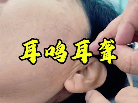 #耳鸣耳聋#传承中医文化 #中医针灸