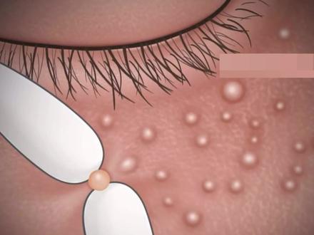 动画演示针清脂肪粒,超解压#脂肪粒 #针清 #医学科普