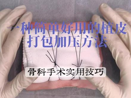 邪修骨登教你如何打包加压!
简单又高效的跨植皮区打包加压方法。可以用在游离皮片移植或者撕脱皮瓣反取皮回植。不需要像传统的打包,粗线固定皮片还要一长一短,留一大堆线头,乱七八糟,还要去平均分配不同方位的线条对称打结,还要去掏棉球或者纱布弄松散,费时费力又不美观,拆包的时候发现很多因为压力过大植皮表皮张力性水泡,表皮真皮分离,皮肤糜烂后续可能还会一部分坏死。我们的方法是5-0角针慕丝线(90cm)间断或者连续缝合固定皮片,无需留线尾不会出现缠绕。植皮区域两边平行分布的就条粗线去加压现成的无菌棉垫又亲肤松软又平坦,省去很多掏棉花的时间。压力均匀保证植皮下不积液,又不至于出现张力性水泡,边缘皮肤又不会因为牵拉坏死。这几年用下来植皮成活率基本接近100%。很少出现不成活或者坏死的。刚成活的皮肤不至于太脆弱。分享给大家,觉得可以的多多点赞、评论、关注、分享、推荐之类的。你们的支持就是我创作的动力。#医学科普 #植皮 #邪修的路子就是野 #伙伴计划 #原创视频创作者