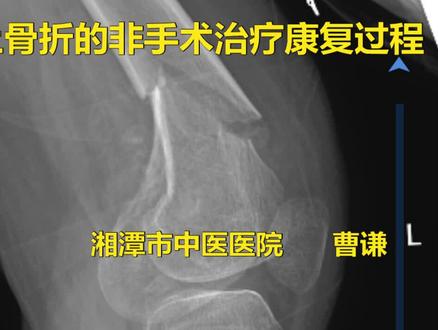 股骨髁上骨折拒绝手术治疗,也可以尝试手法复位石膏外固定治疗,注意固定时间不要过长,避免发生膝关节僵硬,看看这例患者多快可以恢复?#中医正骨 #股骨髁上骨折 #骨折康复 #骨折保守治疗 #非手术治疗