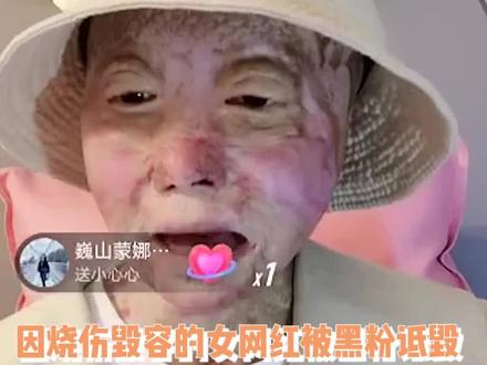 毁容女网红被黑粉诋毁,前追求者:以前看不上我现在送我都不要 #折翼女孩乔燕