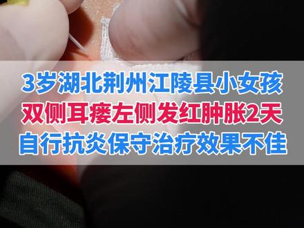 耳前瘘管全麻手术一次麻醉解决两侧问题#耳前瘘管 #抖出健康知识宝藏 #我的年度健康盘点 #武汉陈金辉