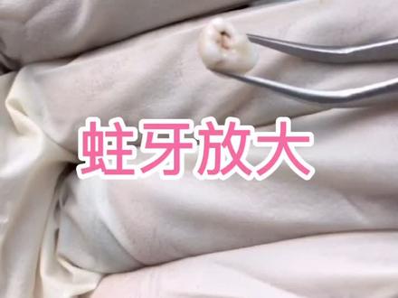 蛀牙放大、看完一定要好好刷牙了#健康 #蛀牙