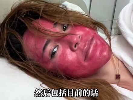 吉林37岁女子长达22年晚上不卸妆,致脸部严重过敏变成深红色 “红肿热烫痒,皮肤像硬壳,不敢见人”#卸妆 #化妆分享