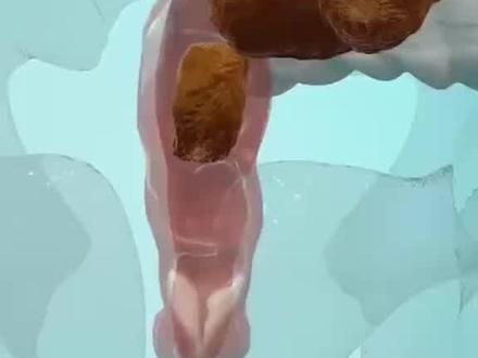 大便变细一定有肠癌吗? #肠癌 #肛肠科 #医学科普