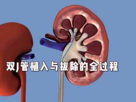 一个视频带你全面了解双J管的置入和拔除的全过程 #肾结石 #微创手术 #肾结石