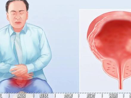 膀胱癌男性高发的恶性癌症!#膀胱癌 #一口气讲透健康知识点 #抖出健康知识宝藏 #医学科普