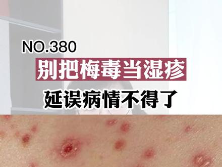 #梅毒 和#湿疹 看着有点像,但是你可得区分好,免得耽误了。#健康科普 #科普 #涨知识