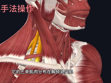 斜角肌手法放松 斜角肌紧张、痉挛会引发的全套症状(神经 + 血管 + 颈椎连锁问题)
斜角肌分前、中、后斜角肌,锁骨下动脉、臂丛神经从前、中斜角肌间隙穿过,肌肉紧张卡压神经血管,临床叫斜角肌综合征,常和颈椎病混淆。
一、神经受压(最常见:臂丛神经卡压)
1. 上肢麻木、刺痛、无力
麻木区域:手臂内侧、小指、无名指尺侧,也可放射到前臂、大拇指、肩膀;
典型表现:抬手、转头、久坐低头后麻木加重,放下手臂、后仰脖子会缓解;
严重:手部握力下降,拿东西易掉落,手指精细动作变差(扣纽扣、写字费力)。
2. 肩颈、前胸放射性疼痛
颈侧、锁骨上方深部酸痛;
痛感放射到肩前、三角肌、上臂内侧,容易误诊肩周炎、心绞痛;
转头、侧屈脖子、深呼吸时痛感明显加剧。
二、血管受压(锁骨下动脉挤压,供血不足)
手臂发凉、发白、发紫
单侧手怕冷,冬天明显,抬高手臂几秒手指就苍白,放下恢复血色;
手部酸胀、易疲劳
拎重物、举手机一会手臂就酸胀发软;
少见严重:指尖循环差、雷诺样发白,长期供血不足会手指萎缩。
三、颈椎、头部连锁不适
单侧偏头痛、太阳穴胀痛
斜角肌附着于颈椎横突,紧张牵拉颈椎,刺激枕下神经,引发侧头痛;
头晕、头昏脑胀
肌肉紧张牵拉椎动脉、卡压交感神经,低头久了头晕加重;
颈椎曲度变直、小关节错位
长期单侧斜角肌紧张,两侧肌力不平衡,颈椎侧弯、旋转错位,反过来加重肌肉劳损,形成恶性循环;
咽喉异物感(少见)
前斜角肌紧邻食道,过度痉挛会有喉咙发紧、吞咽异物感,易误诊梅核气。
四、胸廓出口相关连带问题#
胸闷、胸口发紧
斜角肌参与辅助吸气,紧张时呼吸变浅,胸口压抑,容易误以为心脏不适;
高低肩、肩胛骨前引
斜角肌过度收紧会把锁骨、第一肋骨往上提拉,单侧紧张直接高低肩;#颈椎按摩
#斜角肌 #手指麻木 #颈椎 #颈椎病
继发圆肩驼背:颈前伸人群几乎全部伴随斜角肌紧张。
