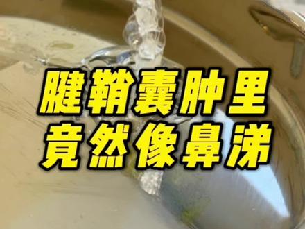 解答很多网友心中的疑惑,腱鞘囊肿内部囊液到底是什么样子 #河南加油 #碰出你的初心 #蓄力奥运快来接招 #