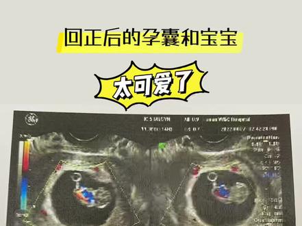 偏宫角妊娠不要怕‼️大概率是可以回正的✅
💁♀️6周+去做第一次B超看胎心胎芽,当时看到报告单上写着“偏有宫角”,说实话,虽然主任医生说“偏”没有关系,适当的保持左侧睡就好。但玻璃心的我还是有些担心的……
🧡非常感谢有类似经历的姐妹,给了我极大的信心,让我相信偏宫角妊娠是可以回正的!现在我把这份正能量继续传递下去~
👉从4月8日查到偏右宫角妊娠开始,我尽量保持左侧睡,还早早的准备起了孕妇枕来辅助。一直坚持到4月27日(历时20天),期间没有出血和剧烈腹痛的情况
👉4月27日,我再次去湖南省妇幼做了B超,复查下孕囊位置是否回正。结果非常惊喜‼️宝宝真的聪明的游到中间来了!医生很温柔的告诉我,宝宝是在正中间,状态非常好~
👏拿到报告单,看到已明显成型的宝宝,真的太太太激动了!悬着的心,也彻底放下来了~
🧡想对所有和我一样,早期出现了“偏宫角妊娠”情况的姐妹说,大家一定不要焦虑、不要害怕,只要遵医嘱保持正确的睡姿辅助调整,保持愉悦的心情,相信宝宝都是聪明的,一定会回正的‼️
#孕期知识 #孕期记录 #偏宫角 #宫角妊娠 #产检一路绿灯 #孕早期 #传好孕