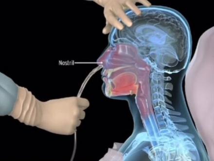 居家护理第三期:插胃管