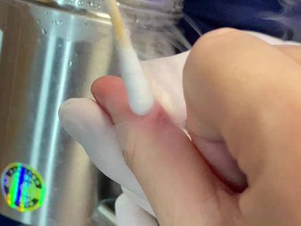 #液氮冷冻瘊子 终于把这个困扰了一年的寻常疣给处理了,这冷冻也不痛啊,哪有网上说的那么邪乎…