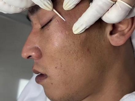 #脂肪粒 挤出来的过程看着就过瘾 有没有想上手的 #专业祛痘 #去黑头粉刺螨虫痘痘