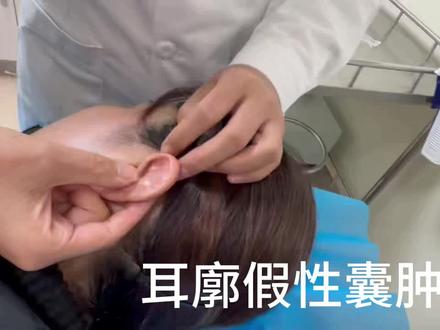 耳廓假性囊肿,穿刺抽液,有妙招