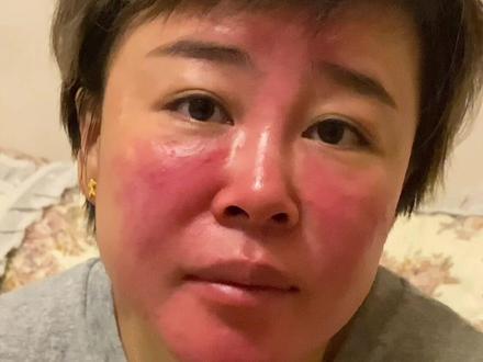 大家都想知道我的脸怎么了?#激素脸 #内容过于真实 @DOU+小助手 @抖音小助手