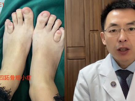 什么是E型短指症?🌟🌹 #E型短指症 #短指症 #短指 #短趾 #短趾症 #第四跖骨短小症 #医学科普