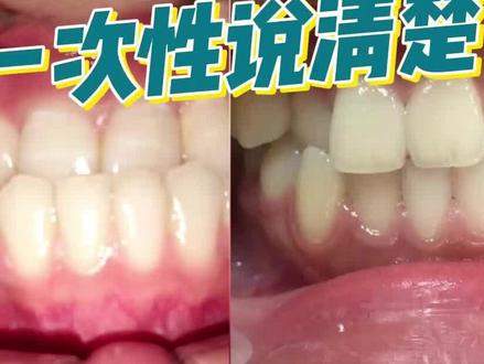 4种咬合问题,一次性说清楚#咬合 #牙颌面畸形 #开启硬核医学科普时代