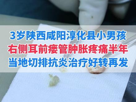 耳前瘘管感染当地切排后再次肿胀,家长不忍心孩子受罪,选择炎症期直接手术#耳前瘘管 #抖出健康知识宝藏 #我的年度健康盘点 #武汉陈金辉