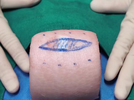 LBD超减张缝合#抖音生活观察计划 #超减张缝合 #美容缝合 #每天学习一点点