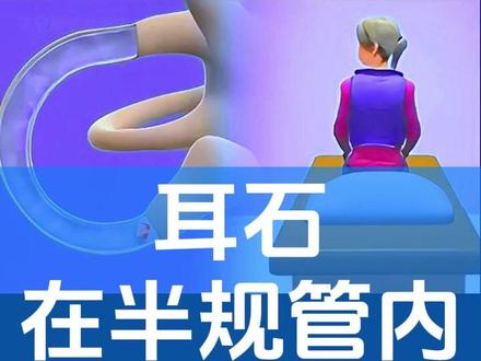 耳石症 动画 解析。这下就清楚了吧!#耳石症 #头晕 #眩晕 #席刚明