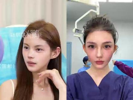 关于联合抗衰 1.0-4.0你应该知道的!!! 个人效果差异,出镜人已签署相关肖像授权,此视频不宣导任何风险医疗项目!出镜人已满25周岁!#抗衰#面部提升三件套#法令纹怎么消除#面部提升#法令纹