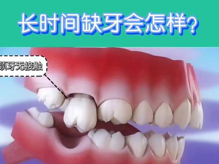 长时间缺牙会怎么样?#健康科普