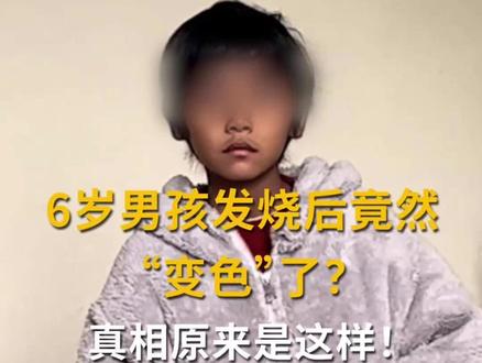 6岁男孩发烧后竟然“变色”了?真相原来是这样!#科普时间到