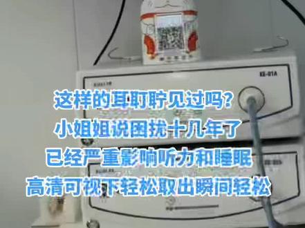 轻松取出困扰十几年顽固耳耵聍,
小姐姐瞬间轻松,恢复听力,很开心