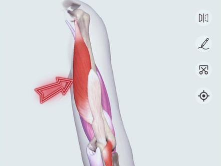 手肘打直会疼怎么办? 回复 @东之木的评论 #排球 #排球🏐 #小排球 #伤病远离球场 #干货分享