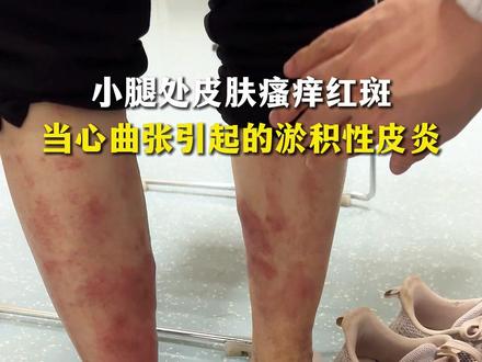 小腿处皮肤瘙痒红斑,当心曲张引起的淤积性皮炎!#静脉曲张 #皮炎 #下肢静脉曲张 #淤积性皮炎 #抖出健康知识宝藏