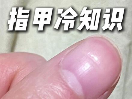 指甲健康检测器,其实藏在指甲上! #抖出健康知识宝藏 #华东医院陈亮 #甲病 #指甲 #博氏线
