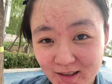 痘坑刷酸,有用吗?#刷酸 #祛痘 #痘坑 #医院