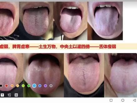 脾虚血虚肝郁舌象学习分享 分享阳气虚,运化弱,引起的血虚舌象。多看图,多思考,培养中医思维,天地自然思维。冬天种不出庄稼,所以必须天暖水温,大地回春,才能种出庄稼。用生活,用自然,理解中医之理#抖出健康知识宝藏 #中医 #舌诊 #中医传承 #增金中医说