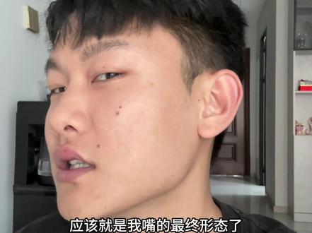 快速丰唇的方法 #蜜蜂叮人 #大学生 #185 #蜜蜂#河里抓青蛙