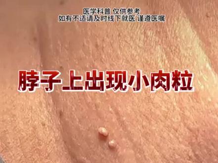 脖子上的两种肉粒,教你分辨和处理!#丝状疣 #皮赘 #科普