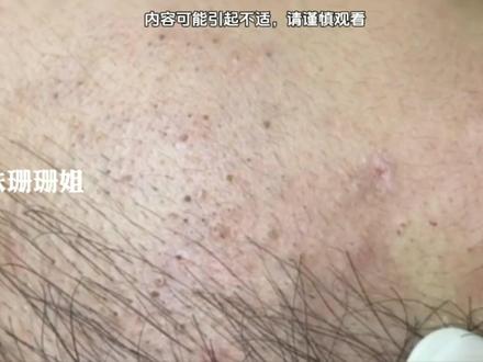 宝子们这期格外的饱满#护肤 #痘痘黑头粉刺拜拜 #细胞夹面部清理工具 #深层毛孔清洁 #解压